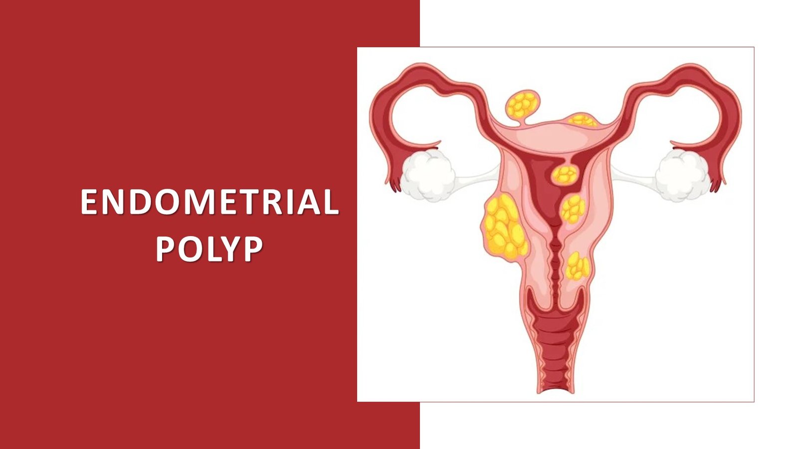 Conquering Endometrial Polyps